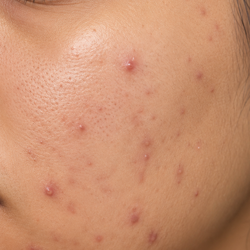 Acne & Breakouts