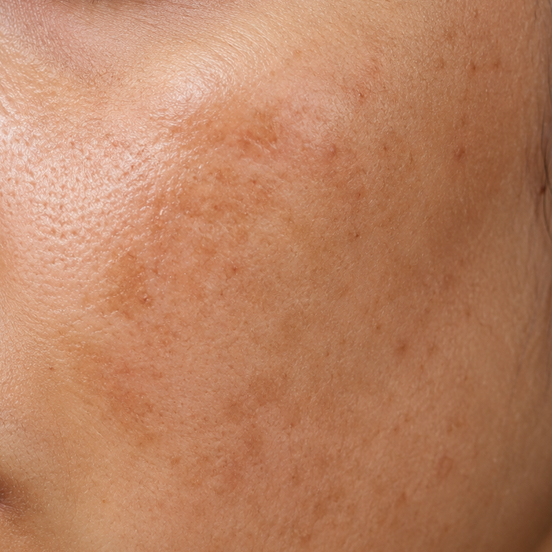 Uneven Skin Tone