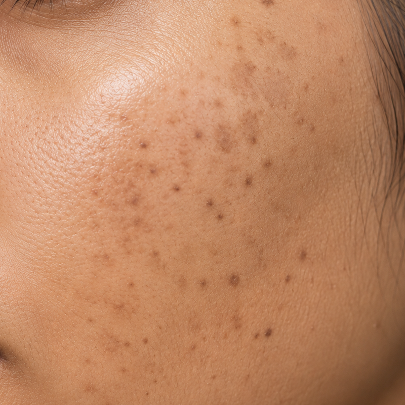 Dark Spots