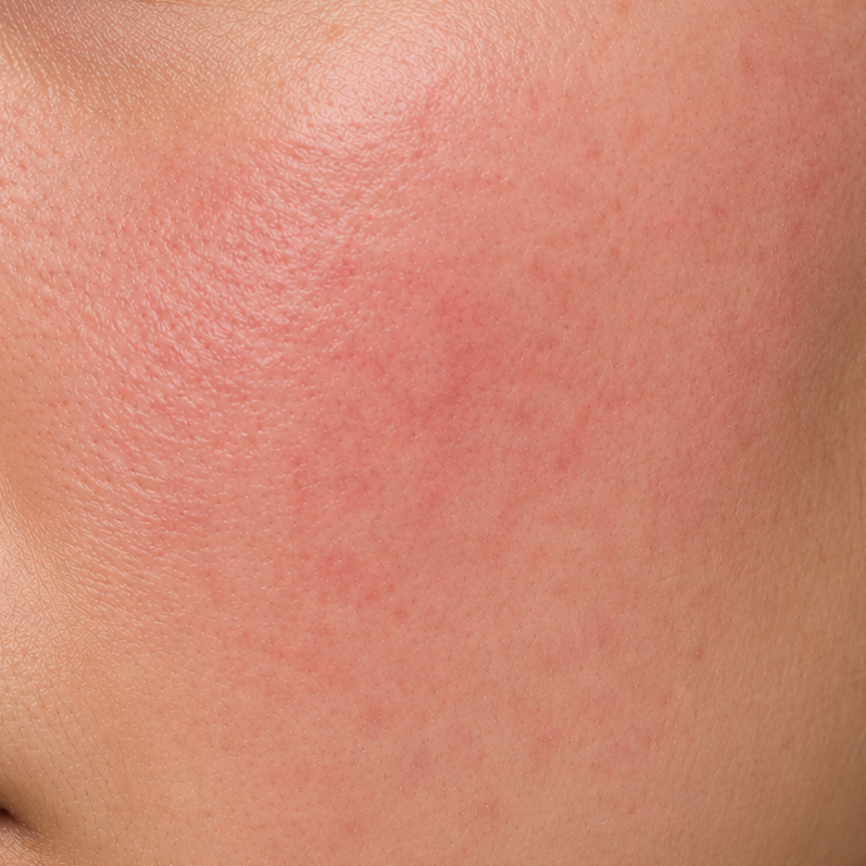 Sensitive Skin